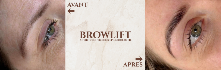 Browlift 